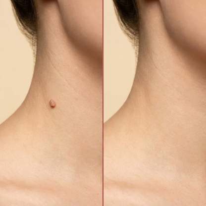 Derma Smooth Skin Tag Removal Patches