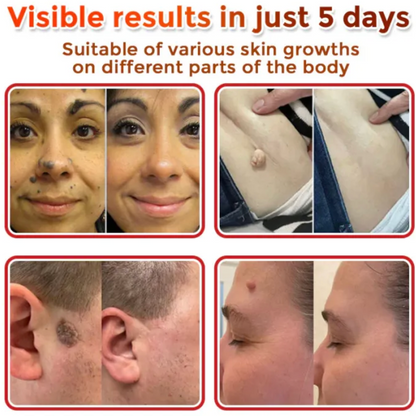 Derma Smooth Skin Tag Removal Patches