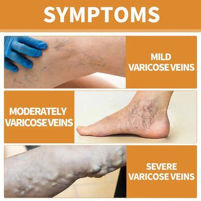 Turmeric Varicose Vein Relief 🔥 BUY 1 GET 2 FREE 🔥