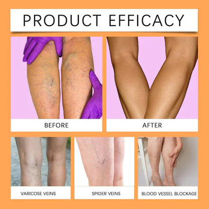 Turmeric Varicose Vein Relief 🔥 BUY 1 GET 2 FREE 🔥